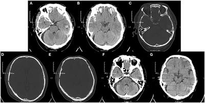 Case report: Acute ischemic stroke caused by intracranial artery dissection in a patient with skull fractures